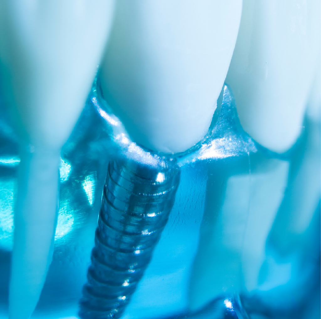 Dental Implants in Magarpatta City Hadapser Pune